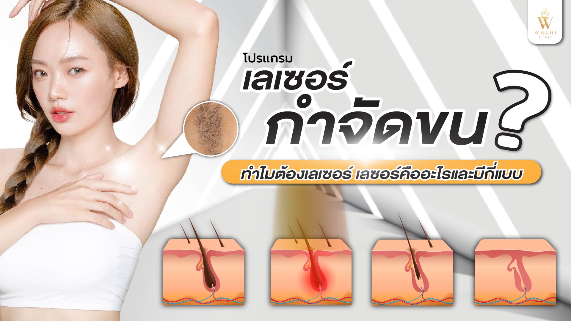 เลเซอร์กำจัดขน คืออะไร?