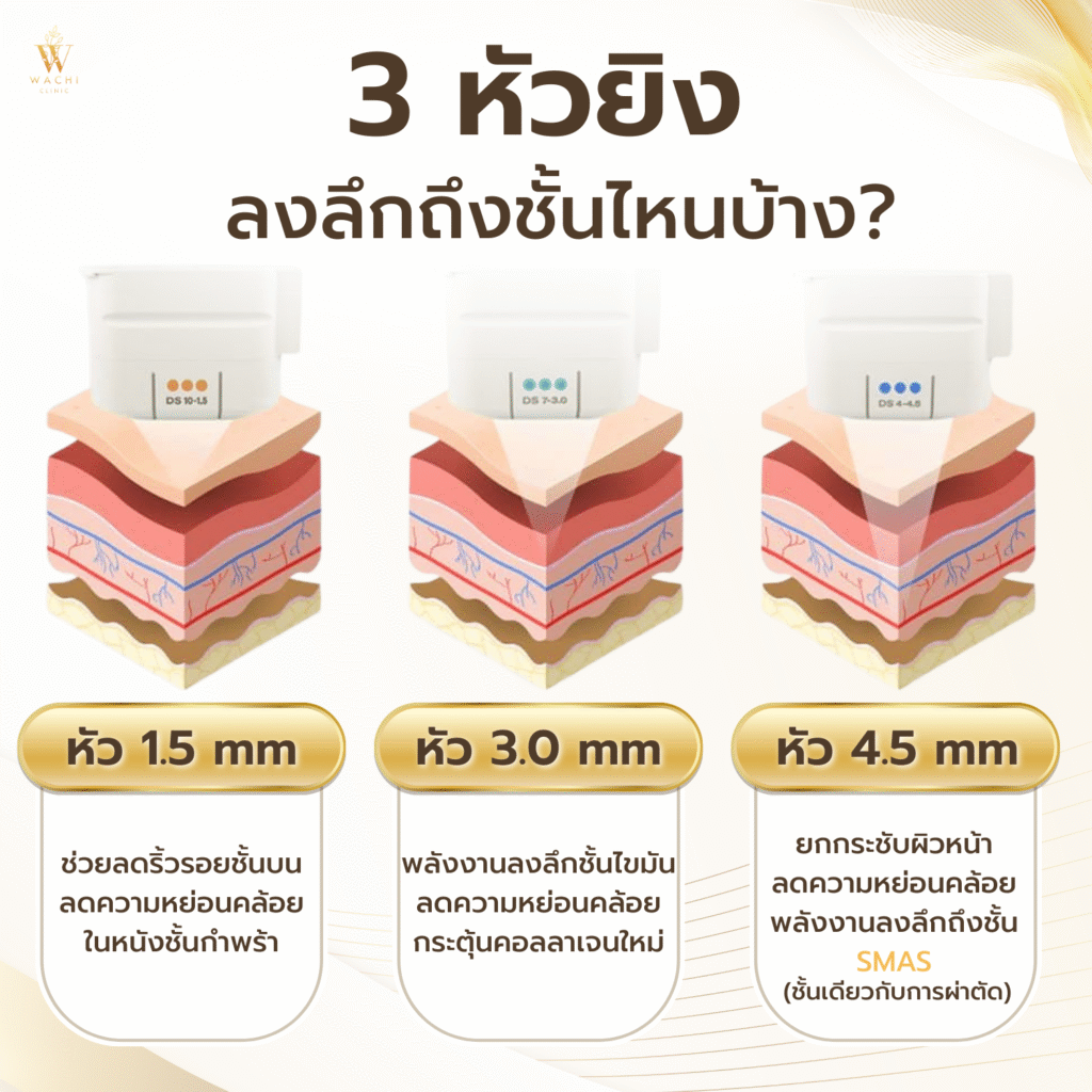 การทำงาน ulthera spt