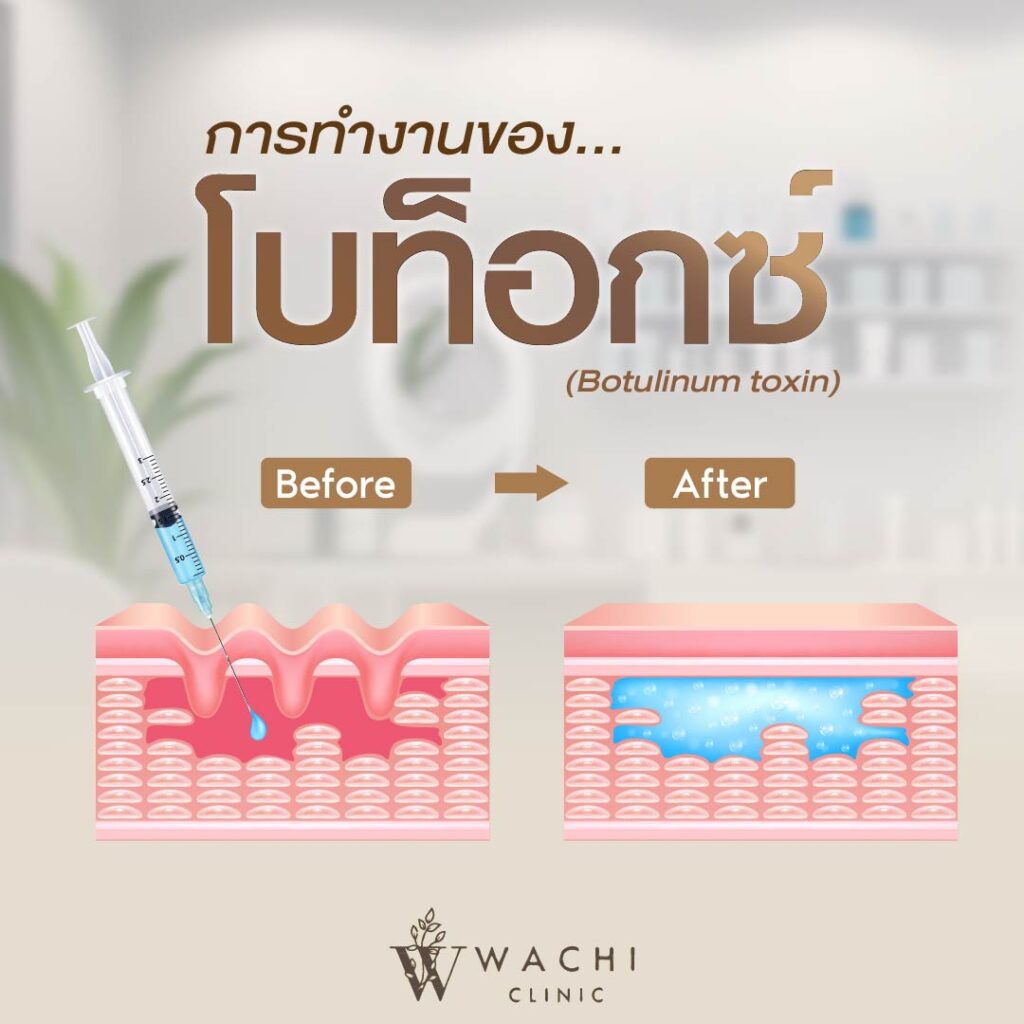การทำงานของโบท็อกซ์