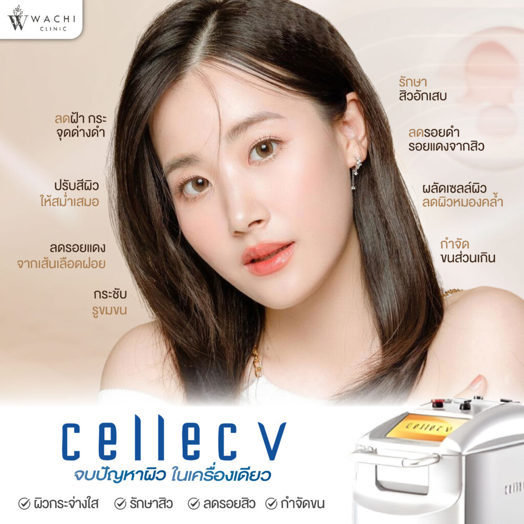 Cellec V IPLช่วยอะไรบ้าง