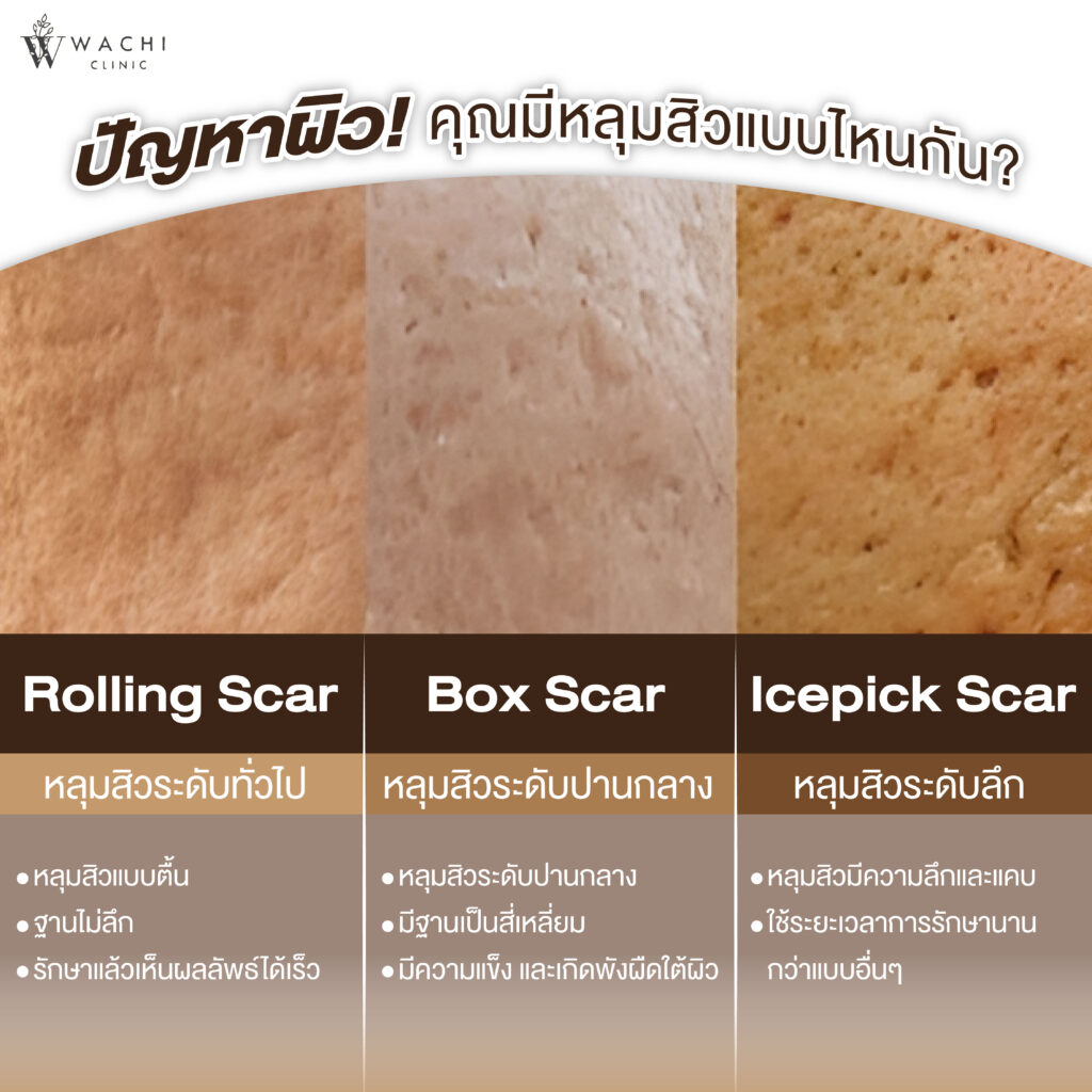 หลุมสิวแต่ละแบบ