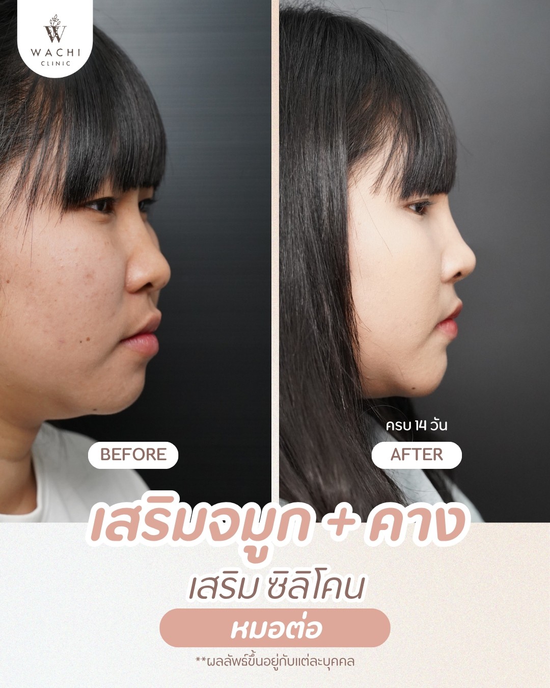 รีวิววาชิคลินิก 1
