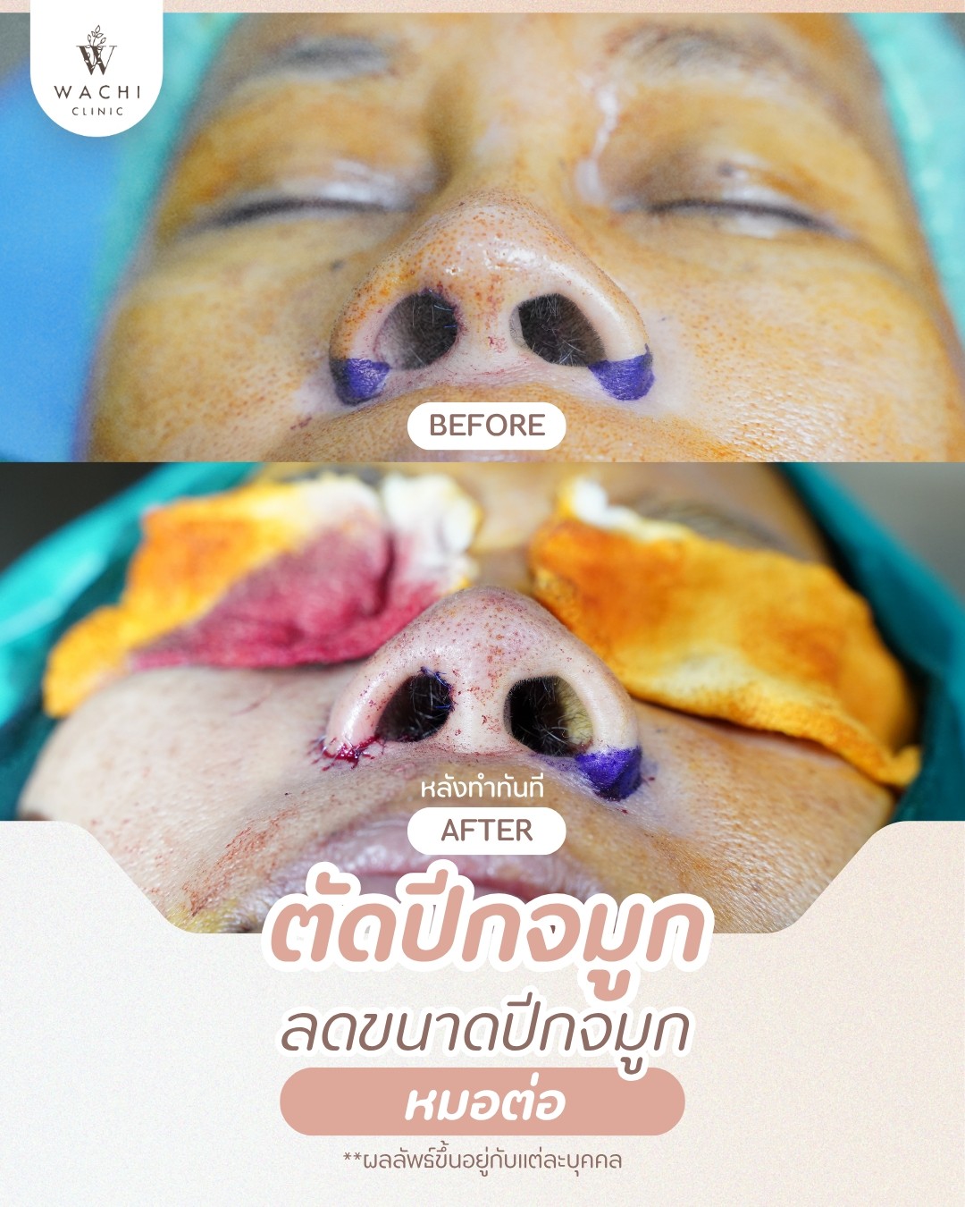 รีวิววาชิคลินิก 11