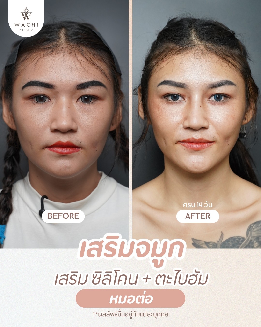 รีวิววาชิคลินิก 13