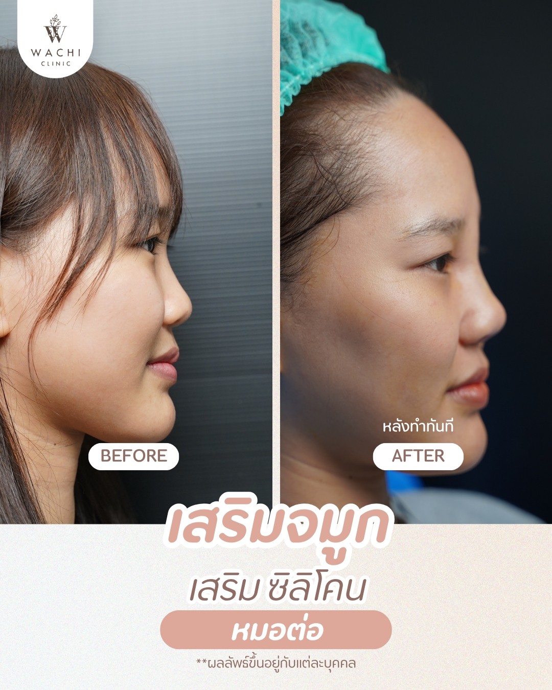 รีวิววาชิคลินิก 14