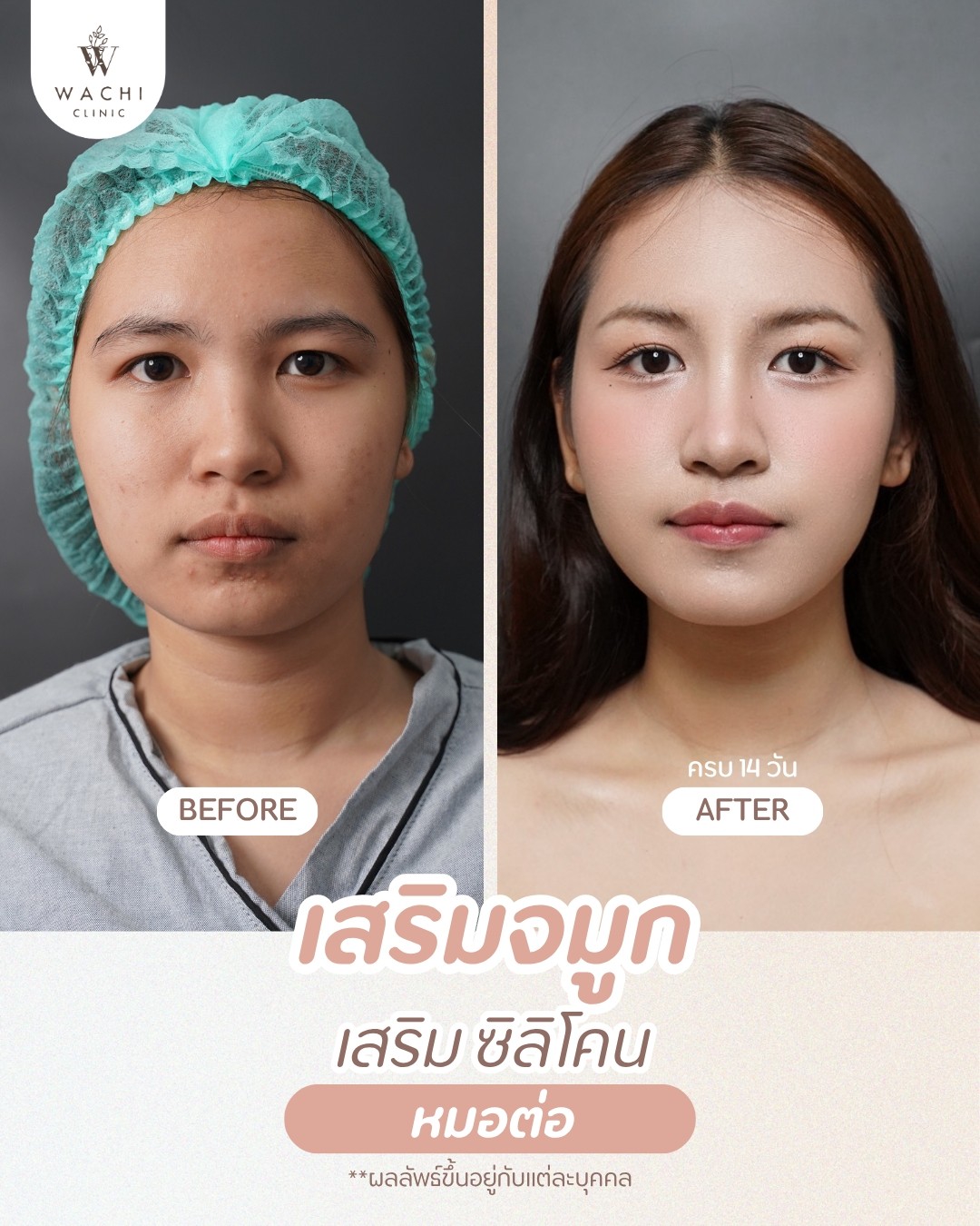รีวิววาชิคลินิก 15