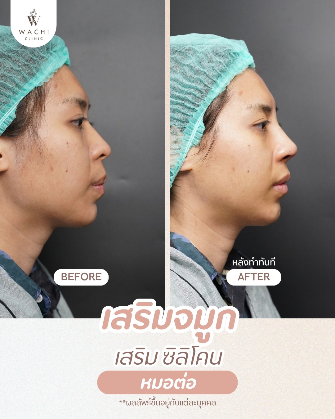 รีวิววาชิคลินิก 17