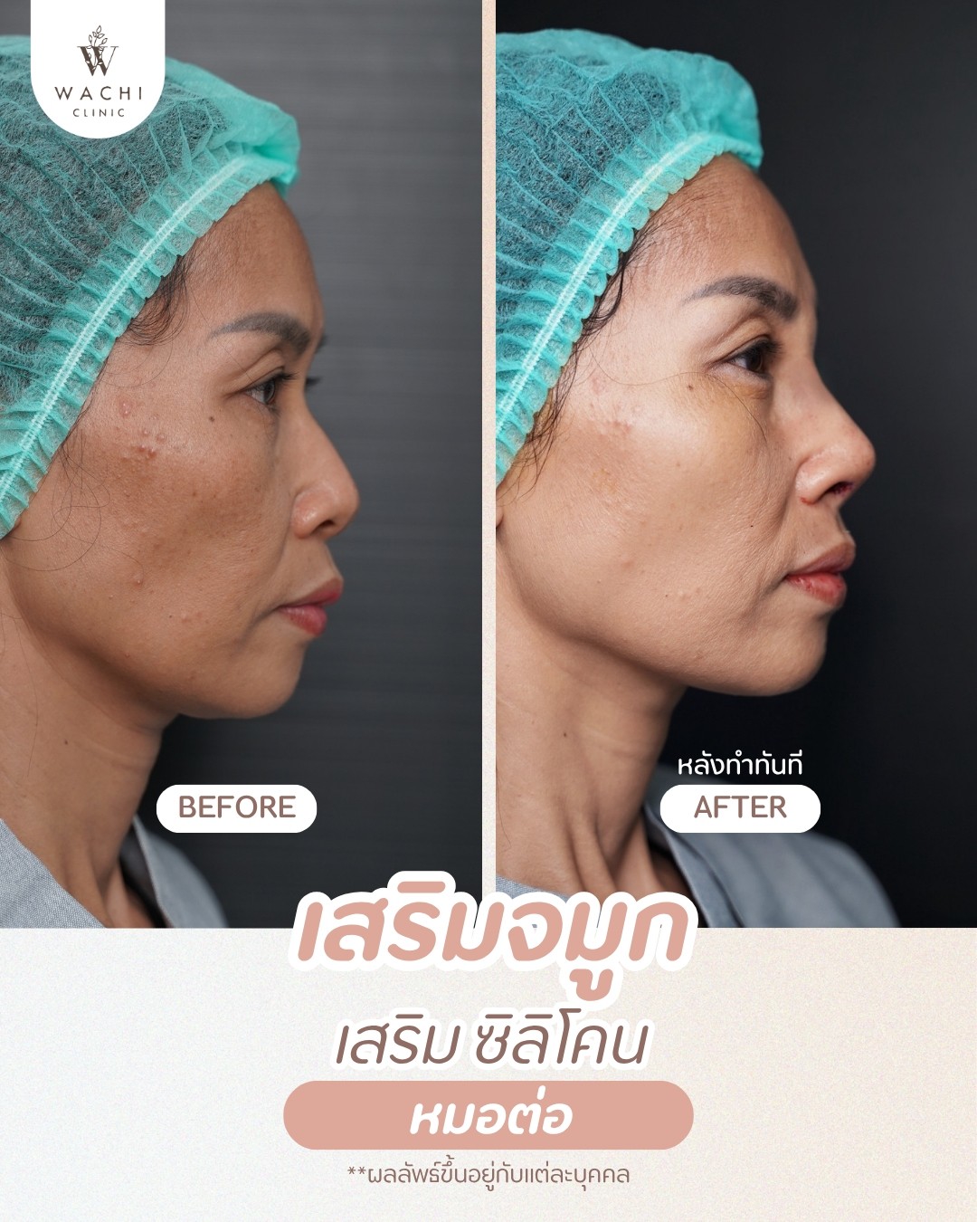 รีวิววาชิคลินิก 19
