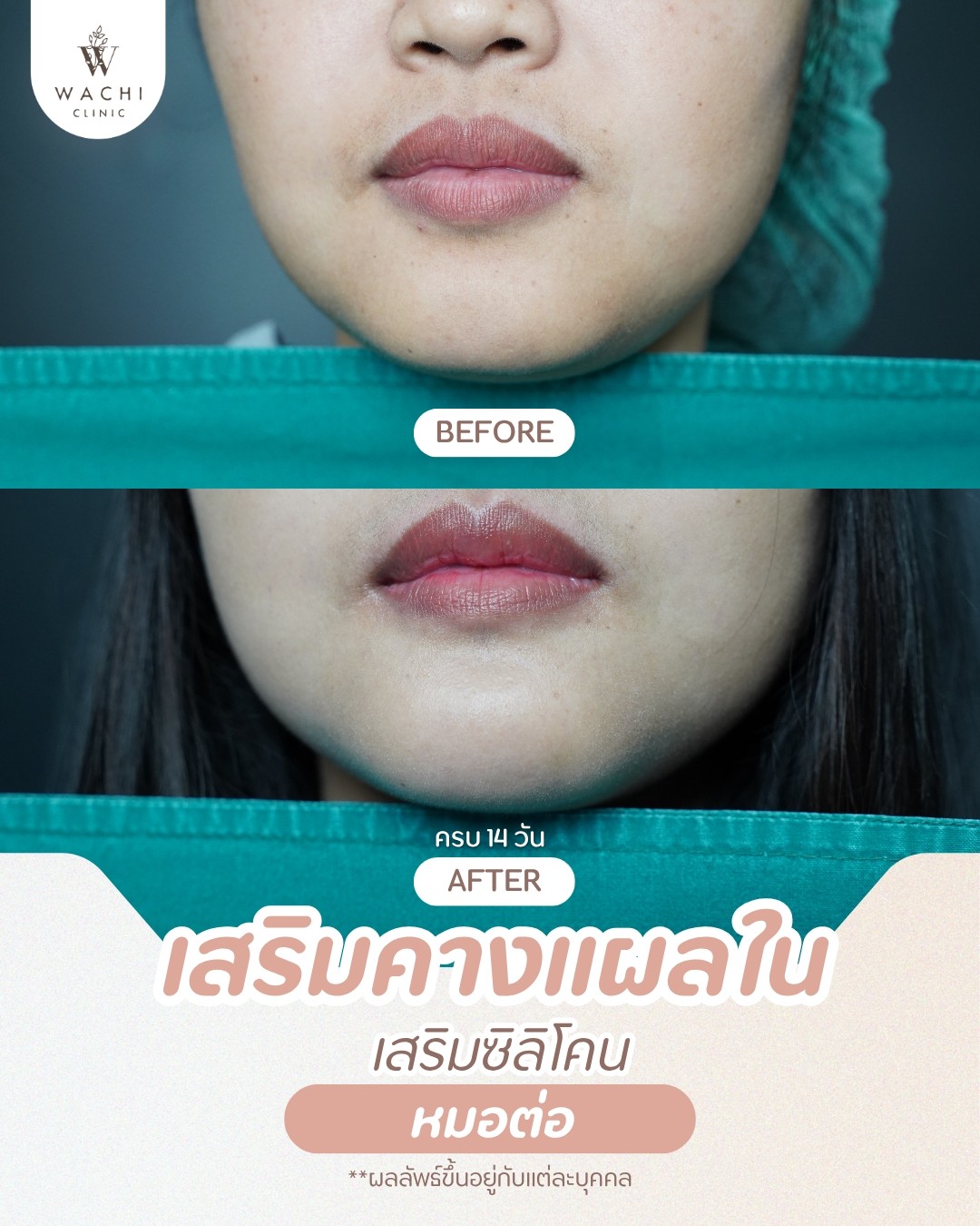 รีวิววาชิคลินิก 20