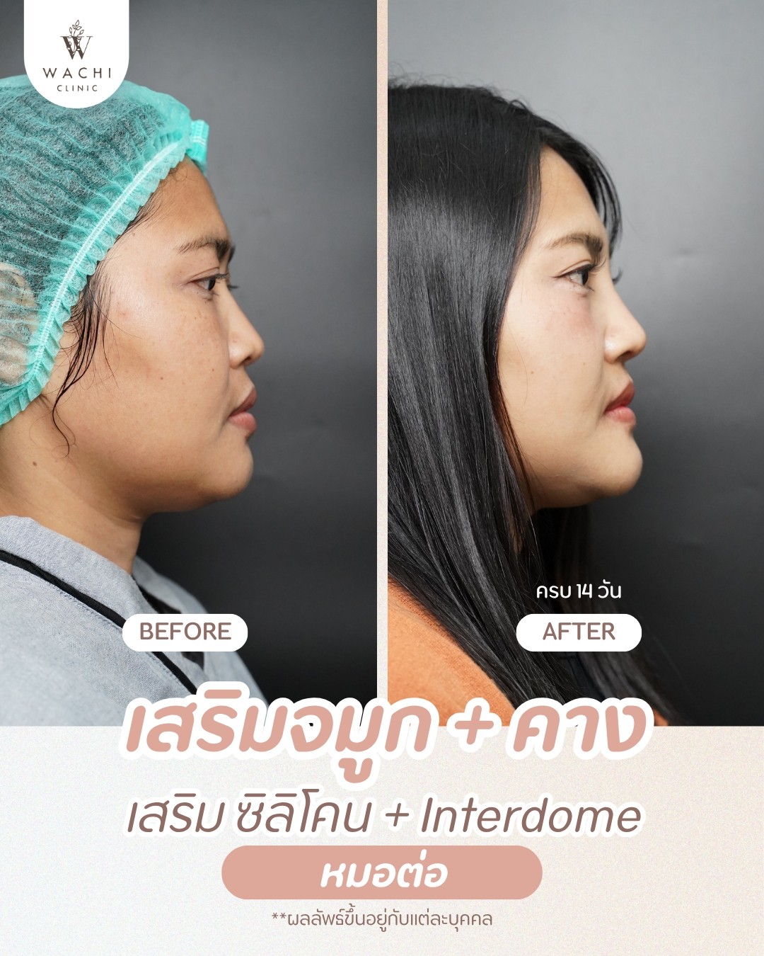 รีวิววาชิคลินิก 21