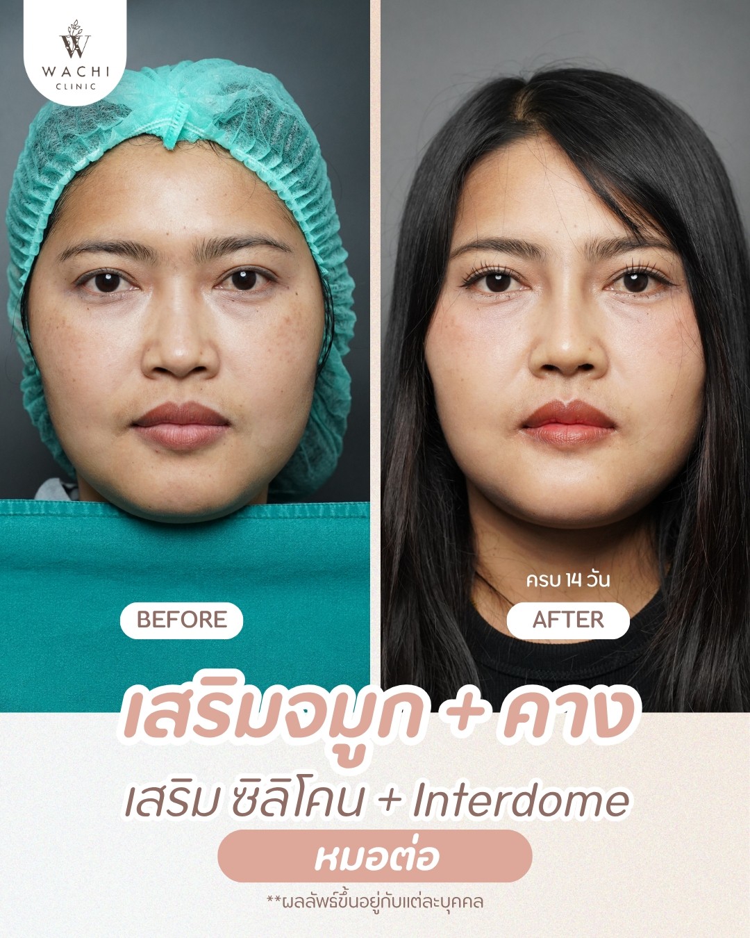 รีวิววาชิคลินิก 22