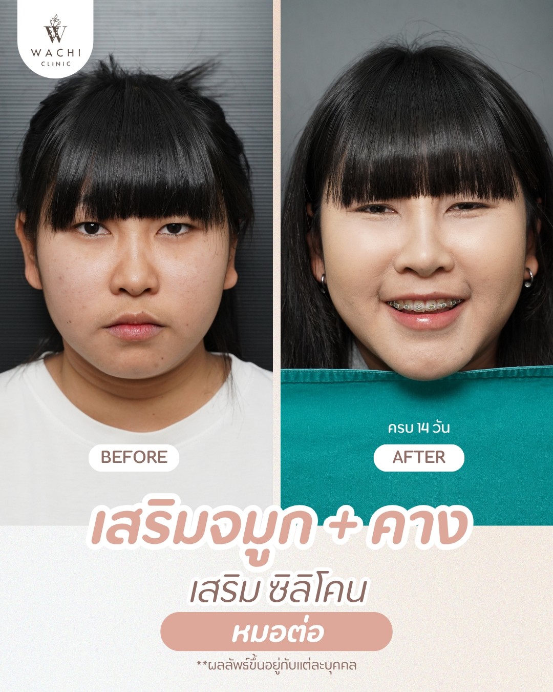 รีวิววาชิคลินิก 23