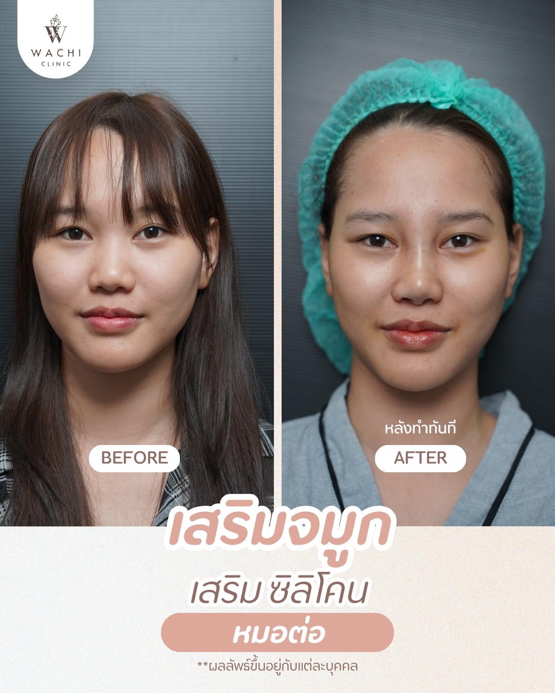 รีวิววาชิคลินิก 25