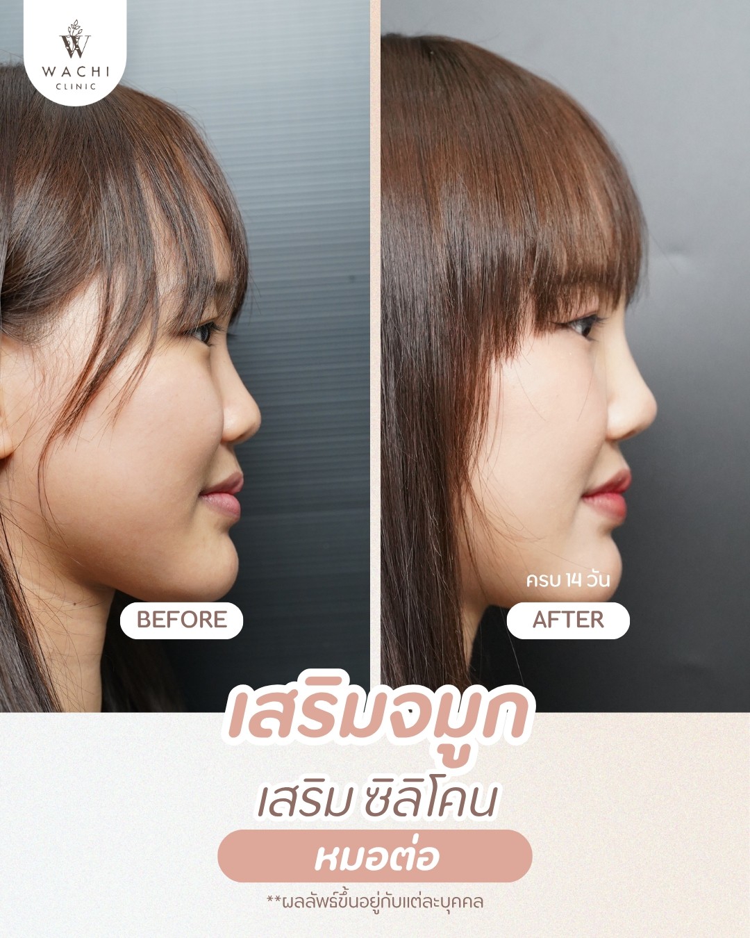 รีวิววาชิคลินิก 3
