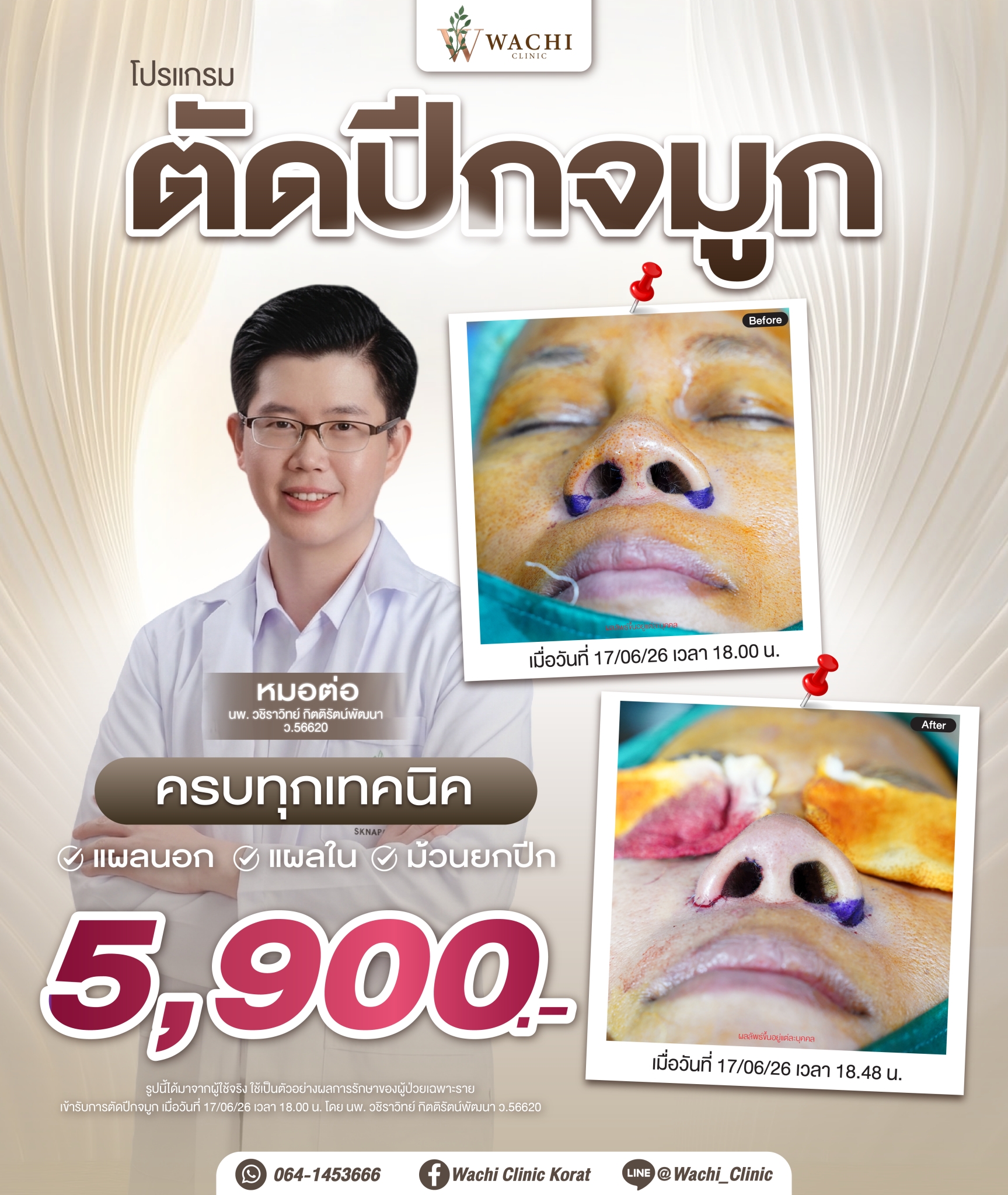 รีวิววาชิคลินิก 30