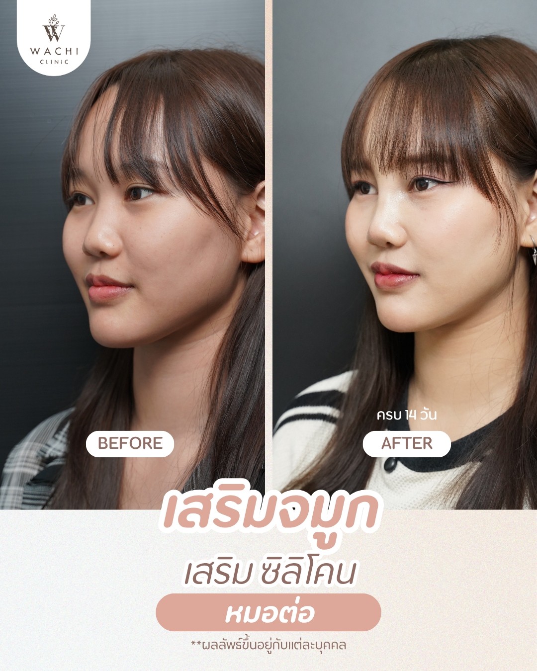 รีวิววาชิคลินิก 4