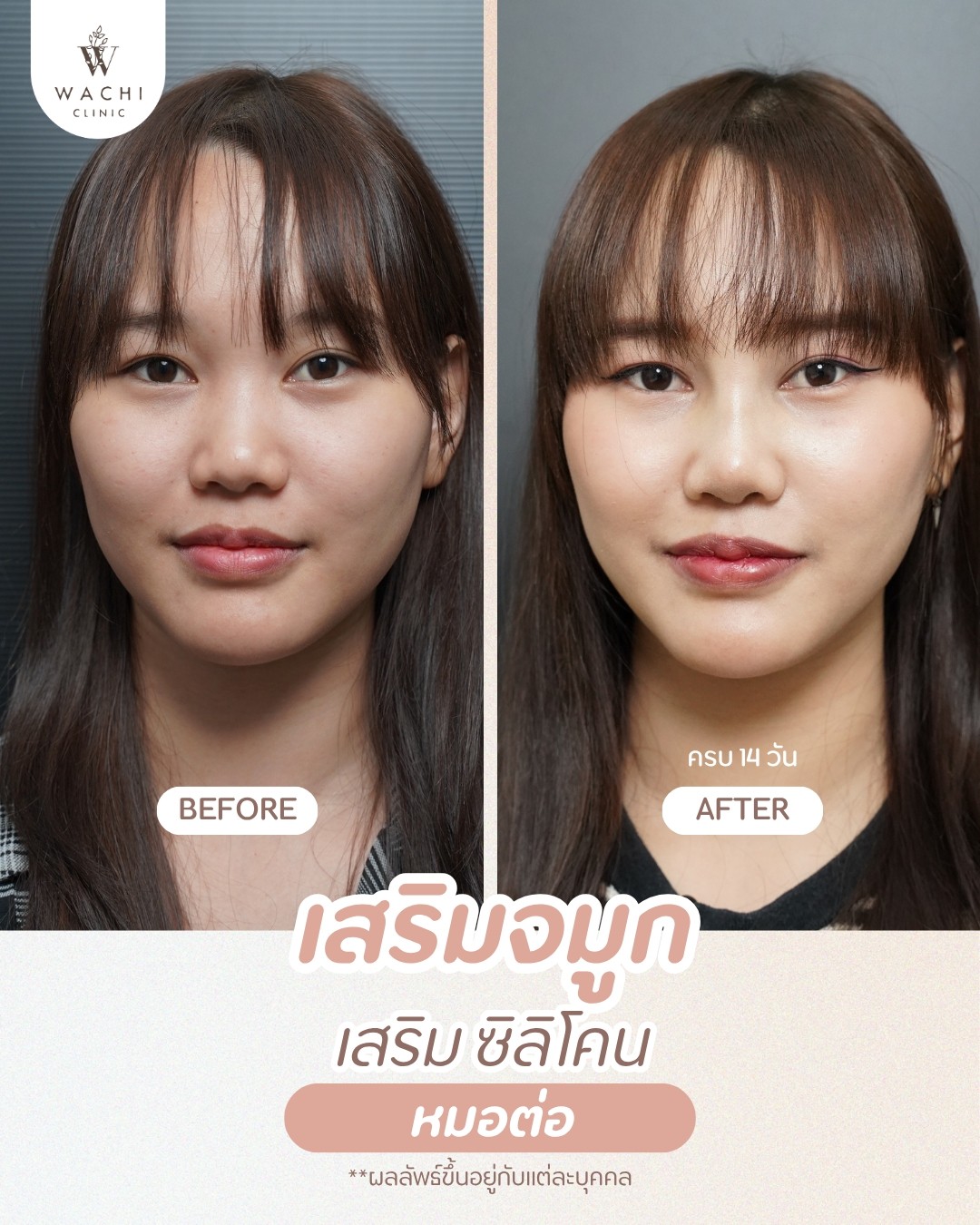 รีวิววาชิคลินิก 5