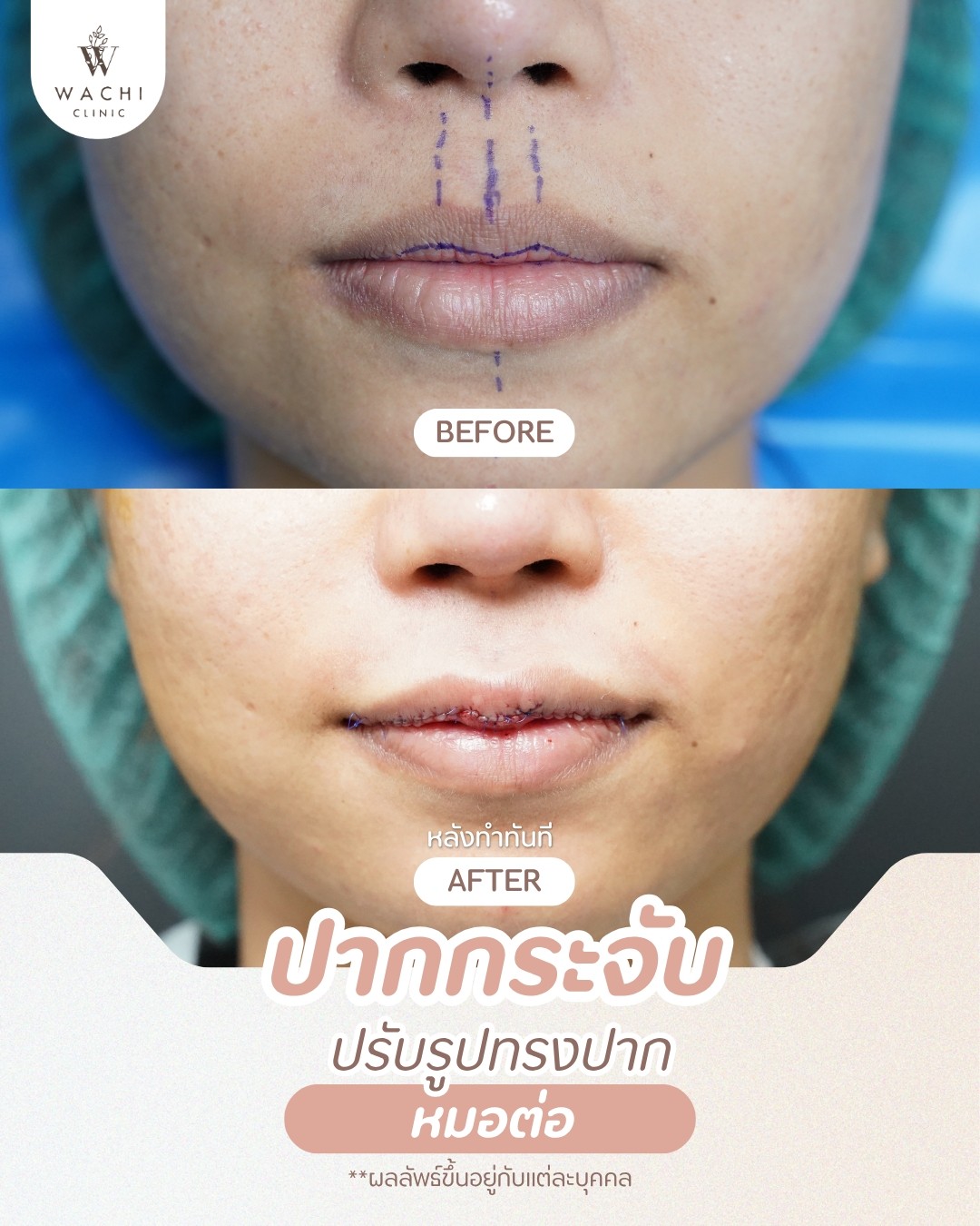 รีวิววาชิคลินิก 6