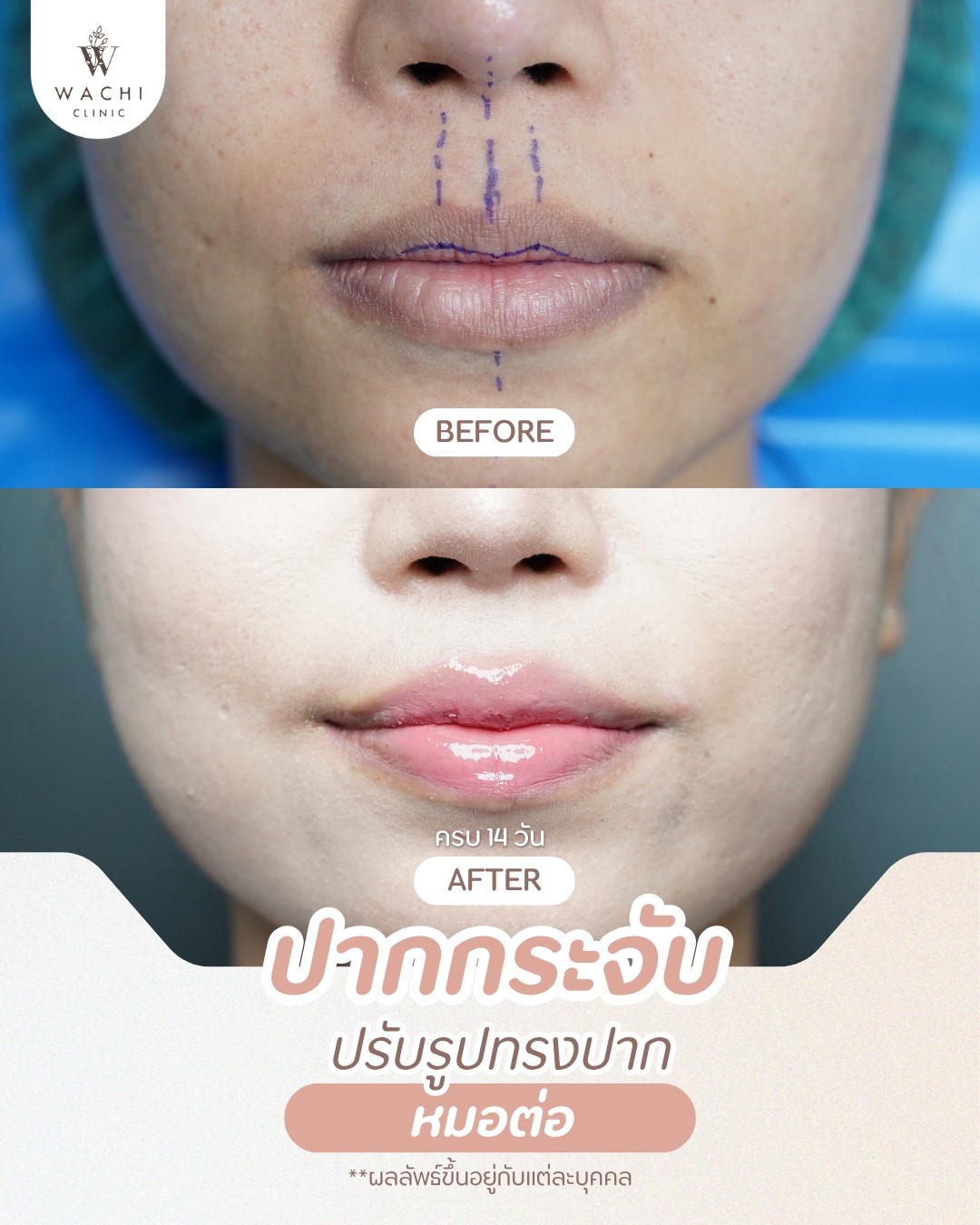 รีวิววาชิคลินิก 7