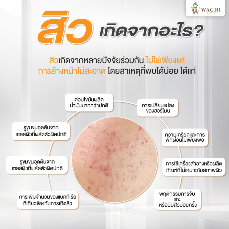 สิวเกิดจากอะไร