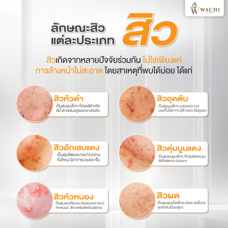 ประเภทสิว
