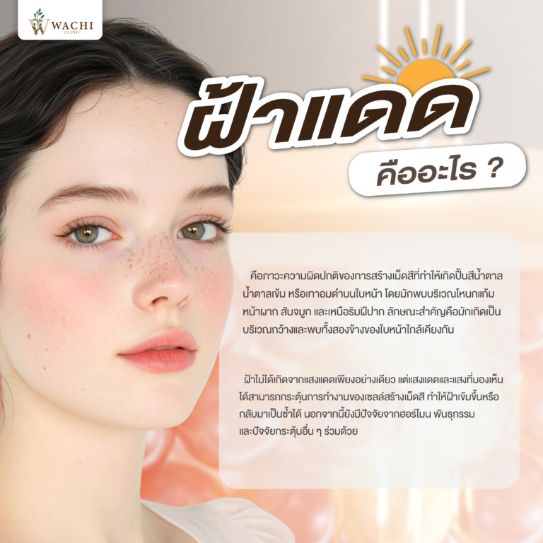 ฝ้าแดด คืออะไร