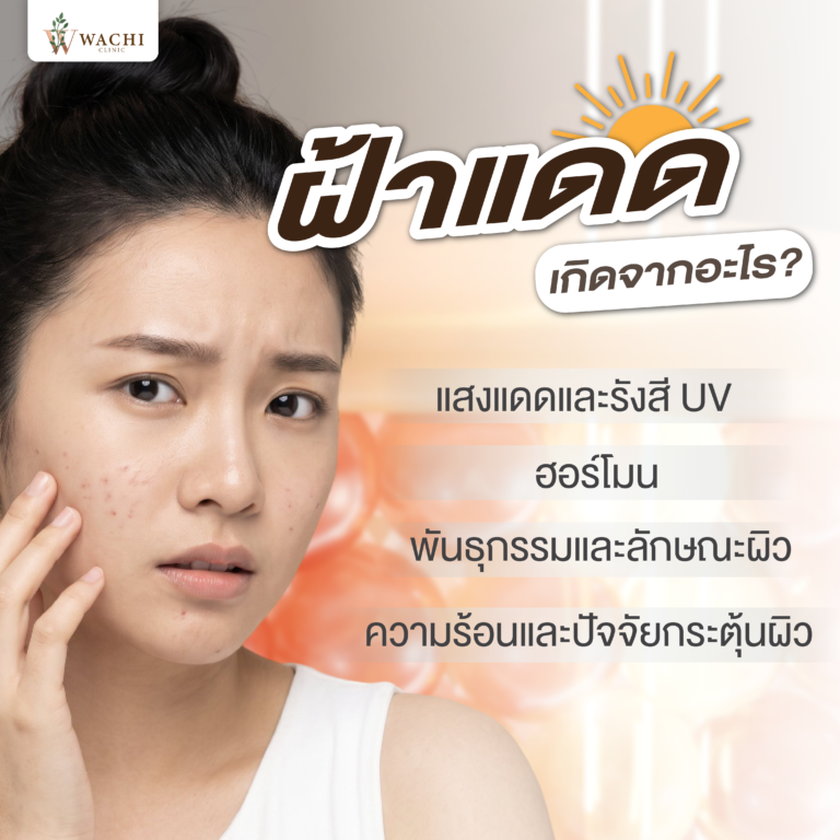 ฝ้าแดดเกิดจากอะไร