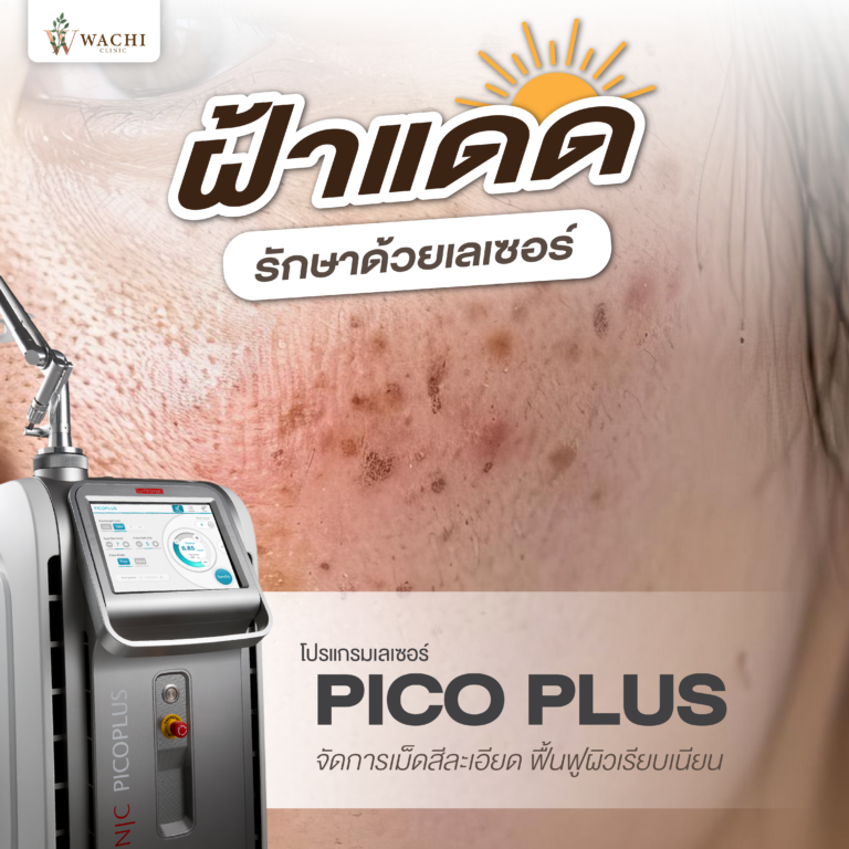 ฝ้า รักษาฝ้า
