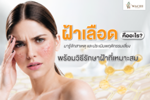 ฝ้าเลือดคืออะไร? สาเหตุและวิธีรักษา | Wachi Clinic โคราช