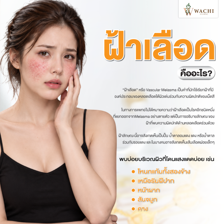 ฝ้าเลือดคืออะไร