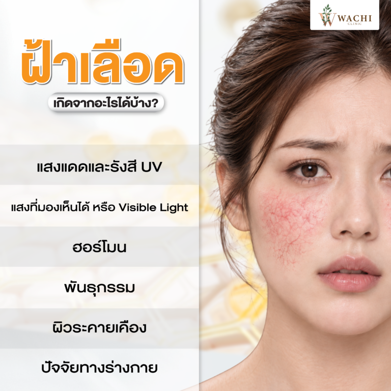 ฝ้าเลือดเกิดจากอะไร