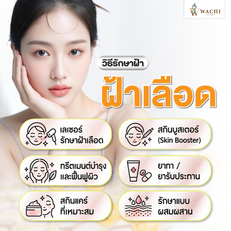 วิธีรักษาฝ้าเลือด