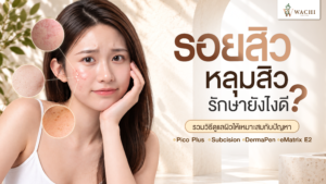 รอยสิว หลุมสิว ต่างกันอย่างไร? รวมวิธีรักษาให้เหมาะกับปัญหาผิว