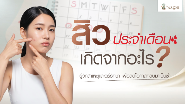 สิวประจำเดือนคืออะไร