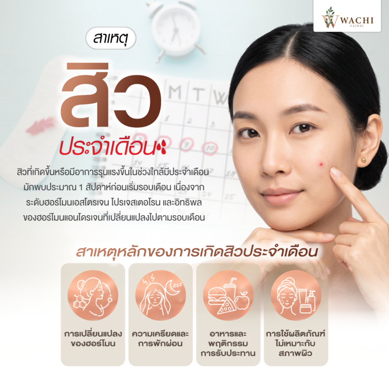 สาเหตุการเกิดสิวประจำเดือน
